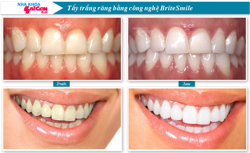 Trước và sau khi tẩy trắng răng Brite Smile