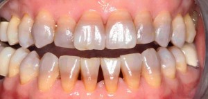 răng bị nhiễm tetra nặng