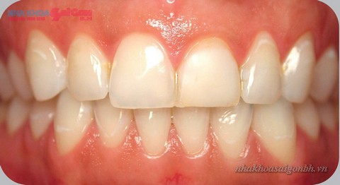 mang bam gay vang rang 1 Tẩy trắng răng có gây hại gì cho răng không