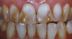 răng bị nhiễm tetracycline