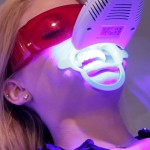 Tẩy trắng răng bằng đèn Plasma có hại gì không?
