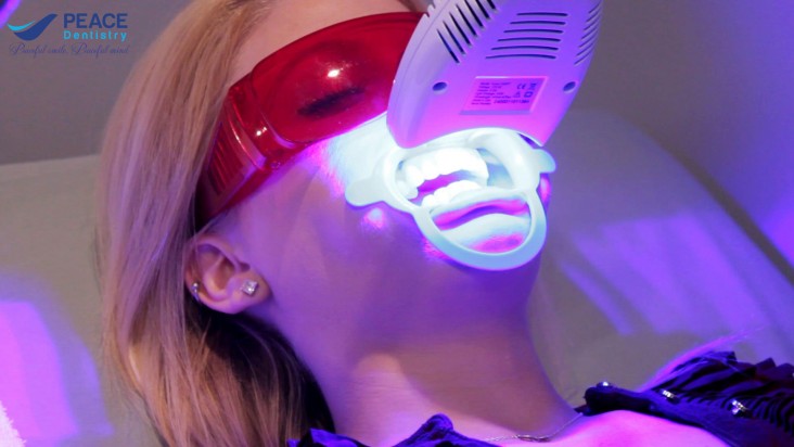Tẩy trắng răng bằng đèn Plasma có hại gì không?