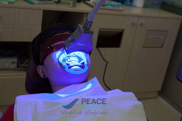 Tẩy trắng răng bằng công nghệ hiện đại nhất