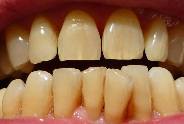 5 thủ phạm khiến răng xinh đổi màu xấu xí